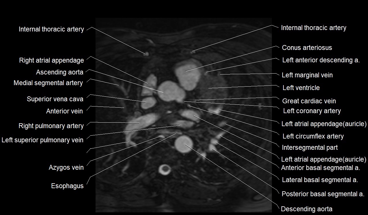 MRI heart coronary arteries and coronary veins anatomy axial image 13.jpg